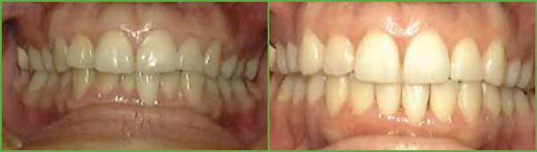 Crossbite teeth before and after — Buffalo Grove, IL — Rosen Orthodontics