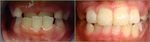 Anterior crossbite teeth before and after — Buffalo Grove, IL — Rosen Orthodontics