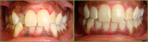 Severe crowding before and after — Buffalo Grove, IL — Rosen Orthodontics