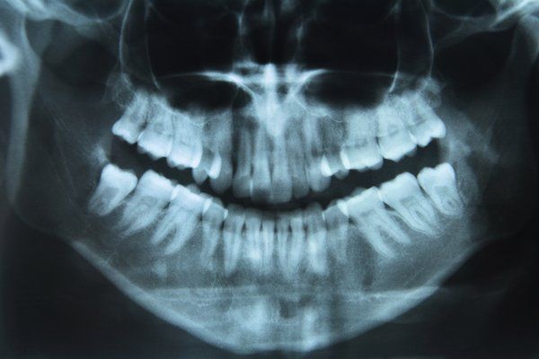Teeth x-ray — Buffalo Grove, IL — Rosen Orthodontics