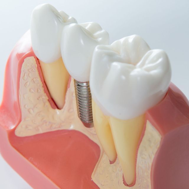 A model of a tooth with a dental implant in it