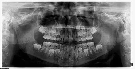 A black and white x-ray of a child 's teeth.