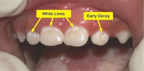 A close up of a child 's teeth showing white lines and early decay