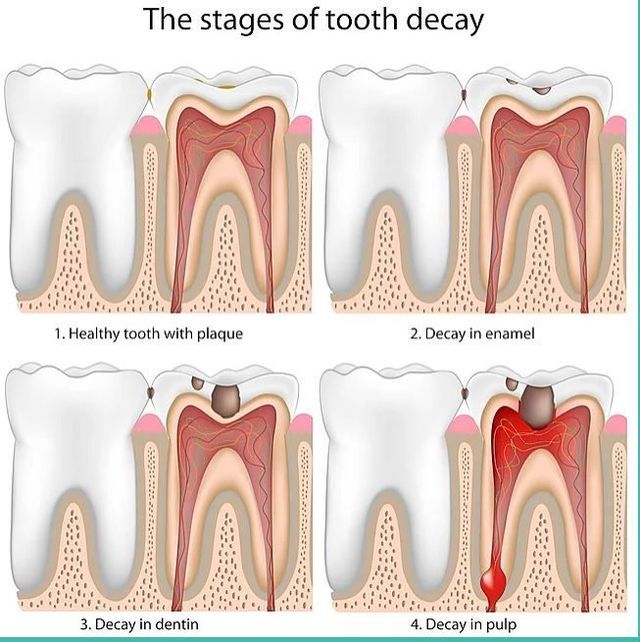 A diagram of the stages of tooth decay.