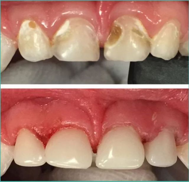 A before and after picture of a person 's teeth