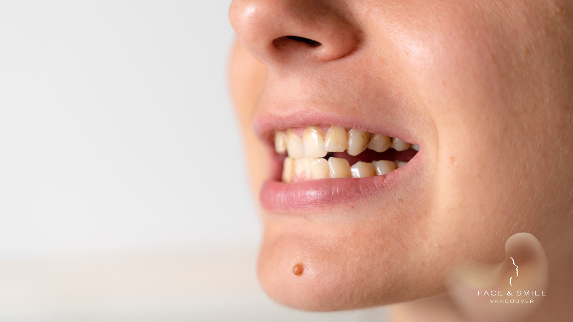 Close-up of a person's mouth, showing slightly discolored teeth and a mole on the chin.