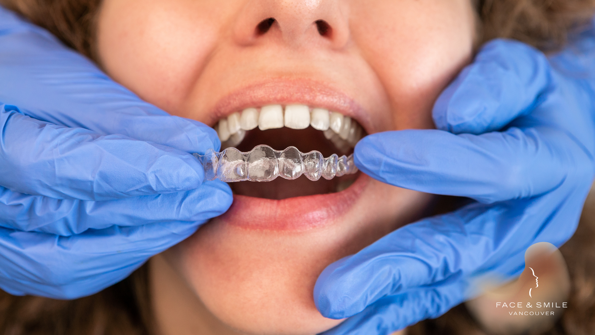 Hands in blue gloves putting clear aligners into a mouth.