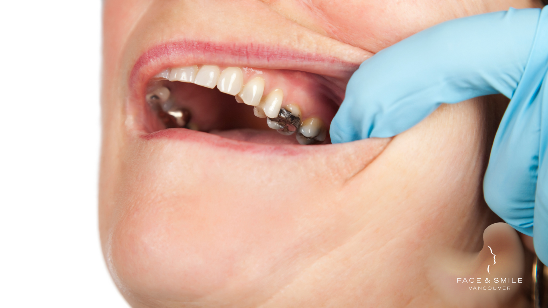 A woman is getting her teeth examined by a dentist.