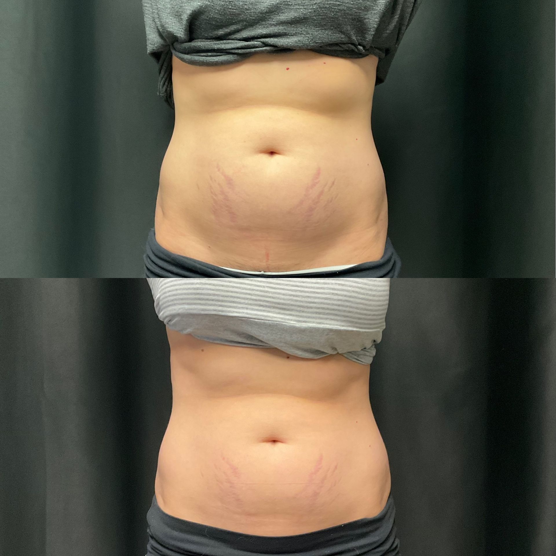 A before and after photo of a woman 's stomach.