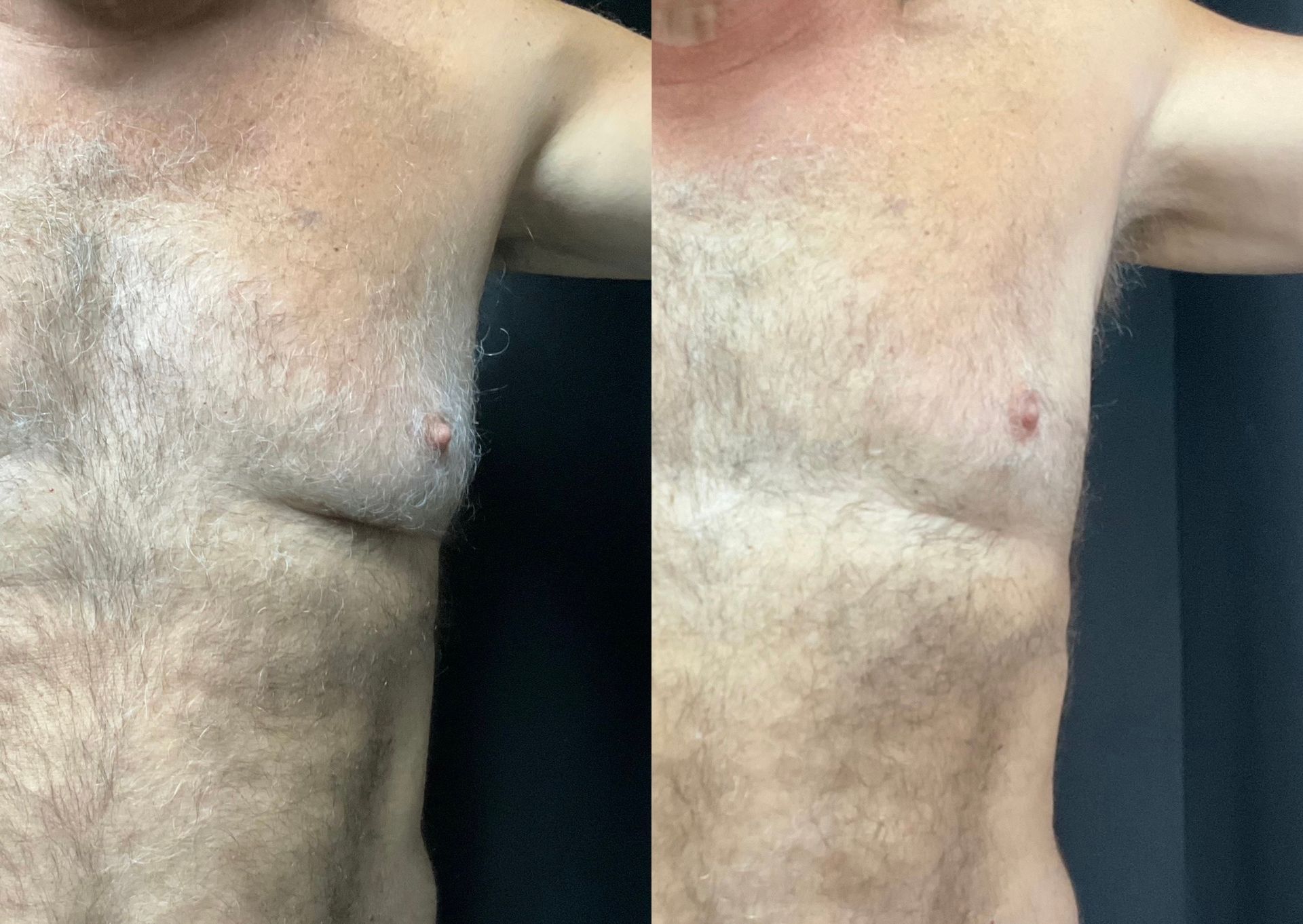 A before and after photo of a man 's chest.