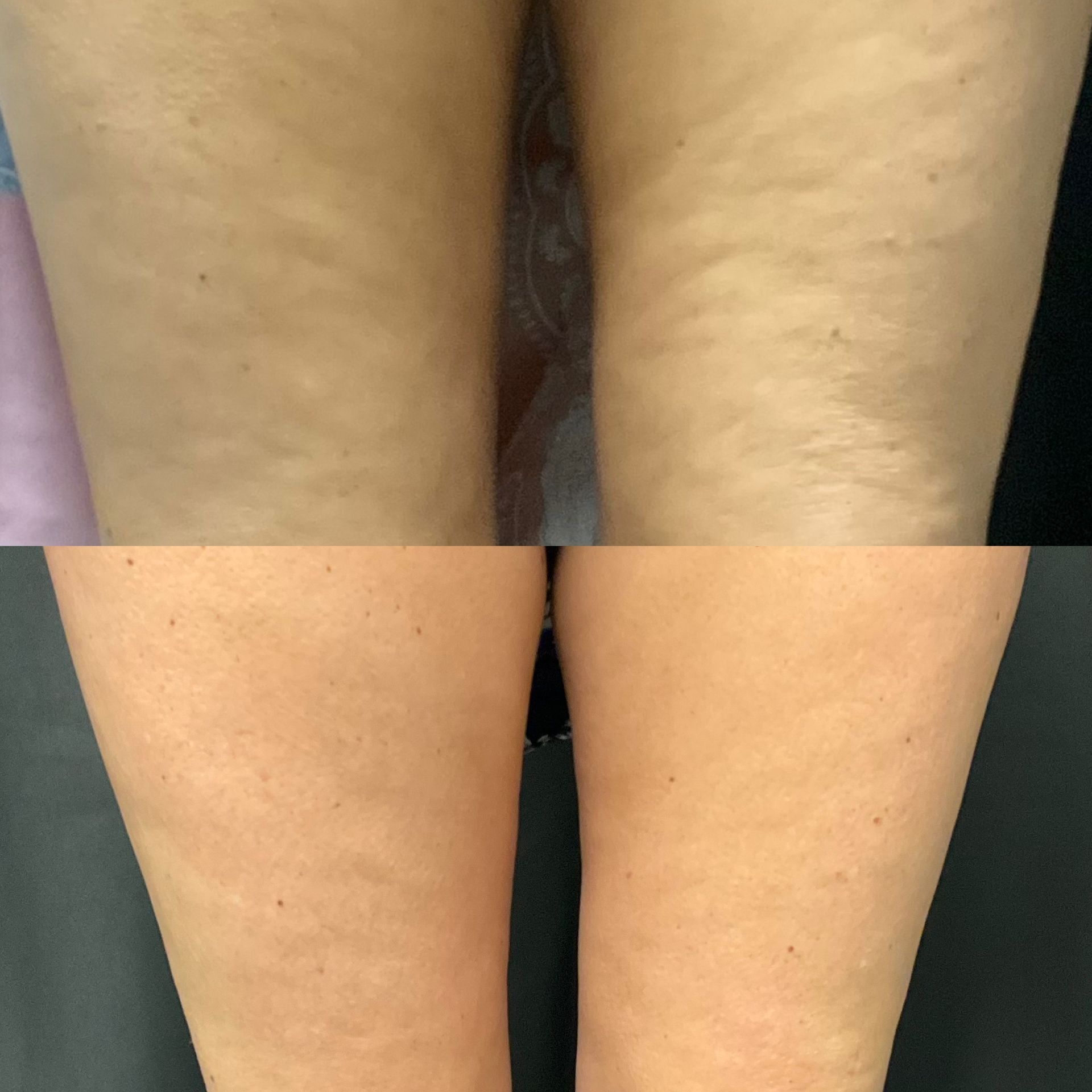 A before and after photo of a person 's legs