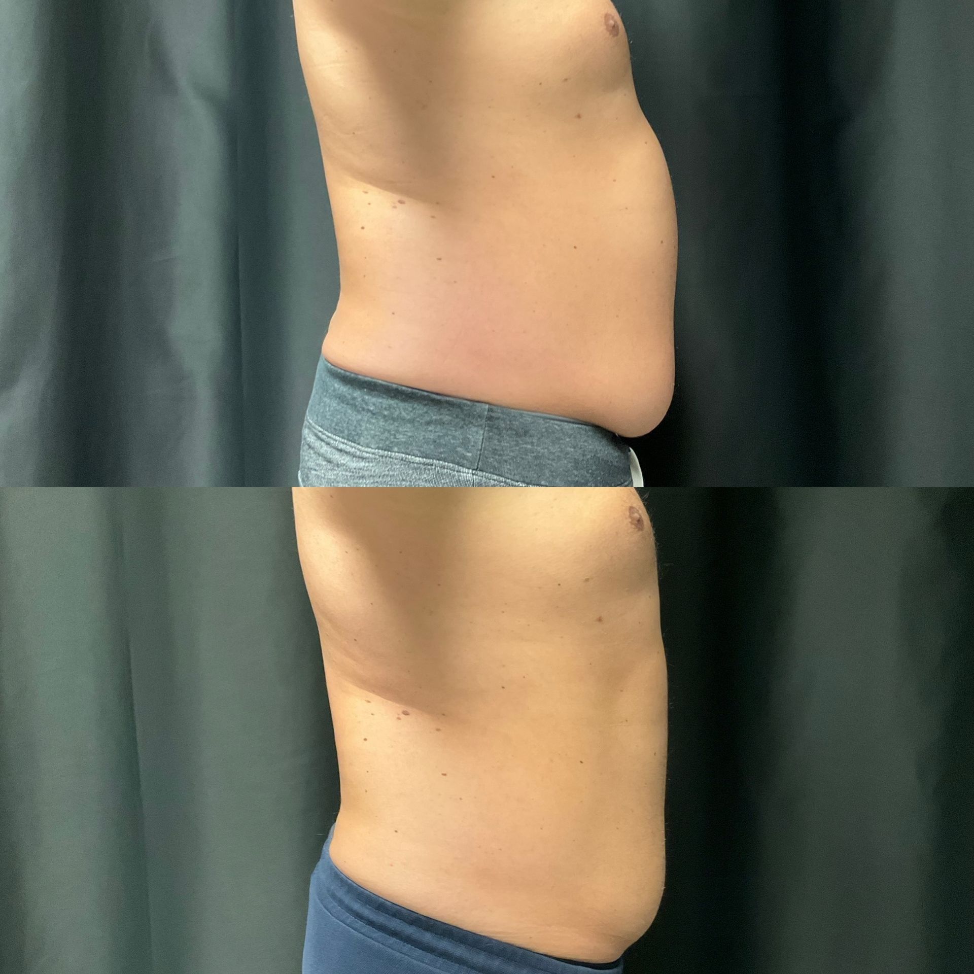 A before and after picture of a man 's stomach.