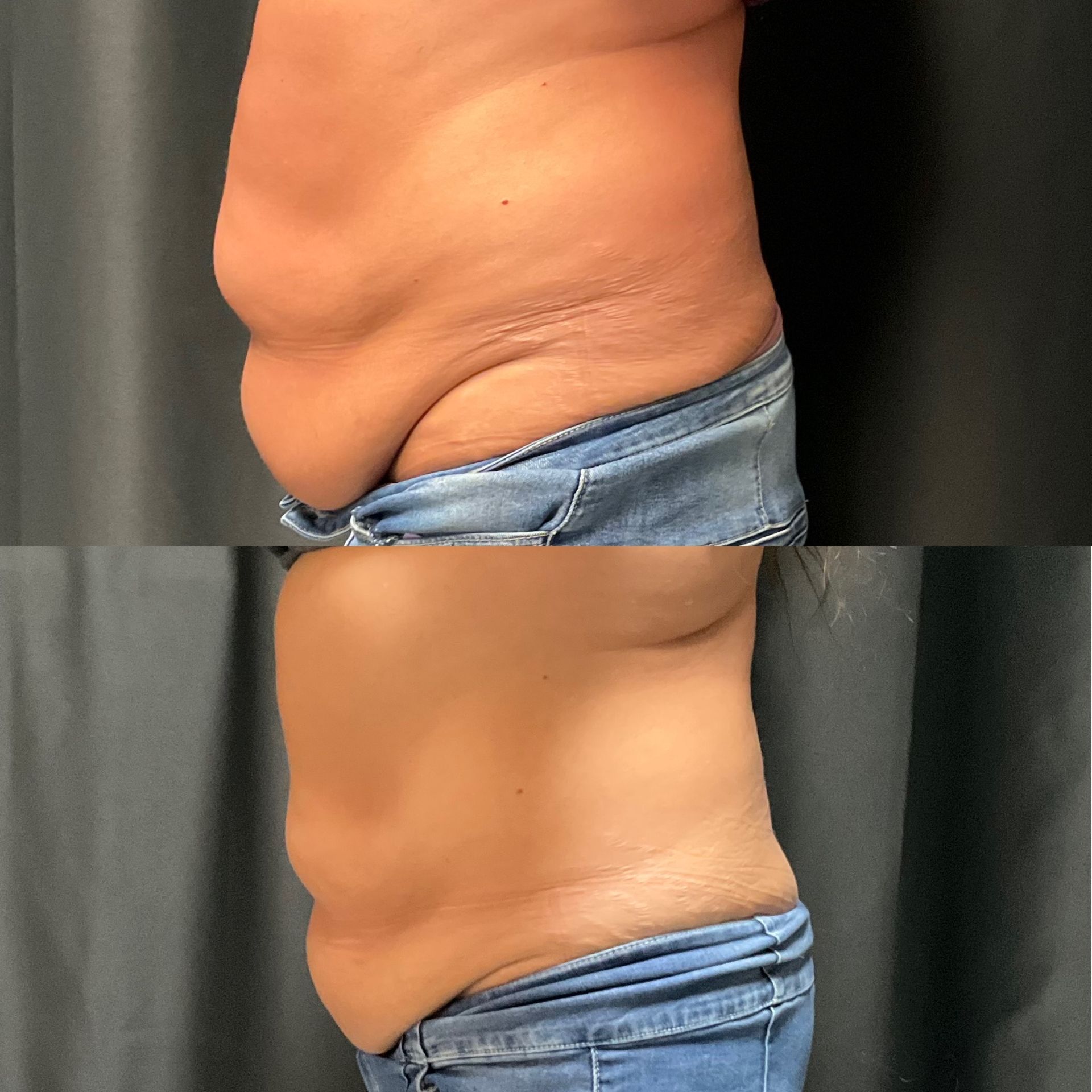 A before and after photo of a woman 's stomach.