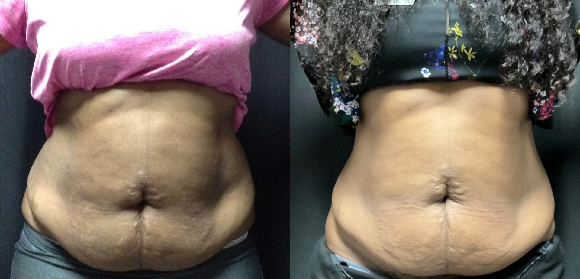 A before and after photo of a woman 's stomach.