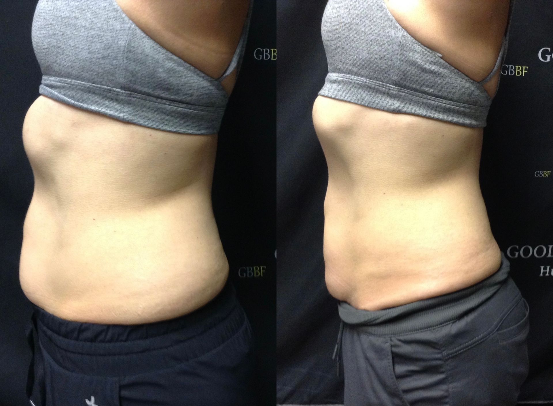 A before and after picture of a woman 's stomach.