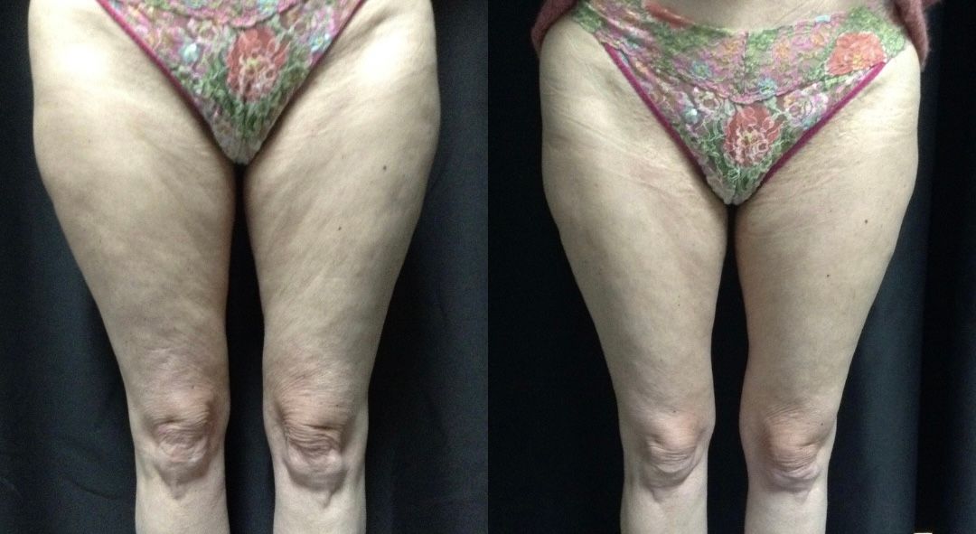 A woman 's legs are shown before and after a treatment.