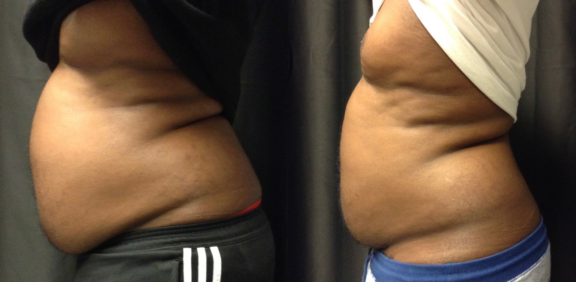 A before and after picture of a person 's stomach.