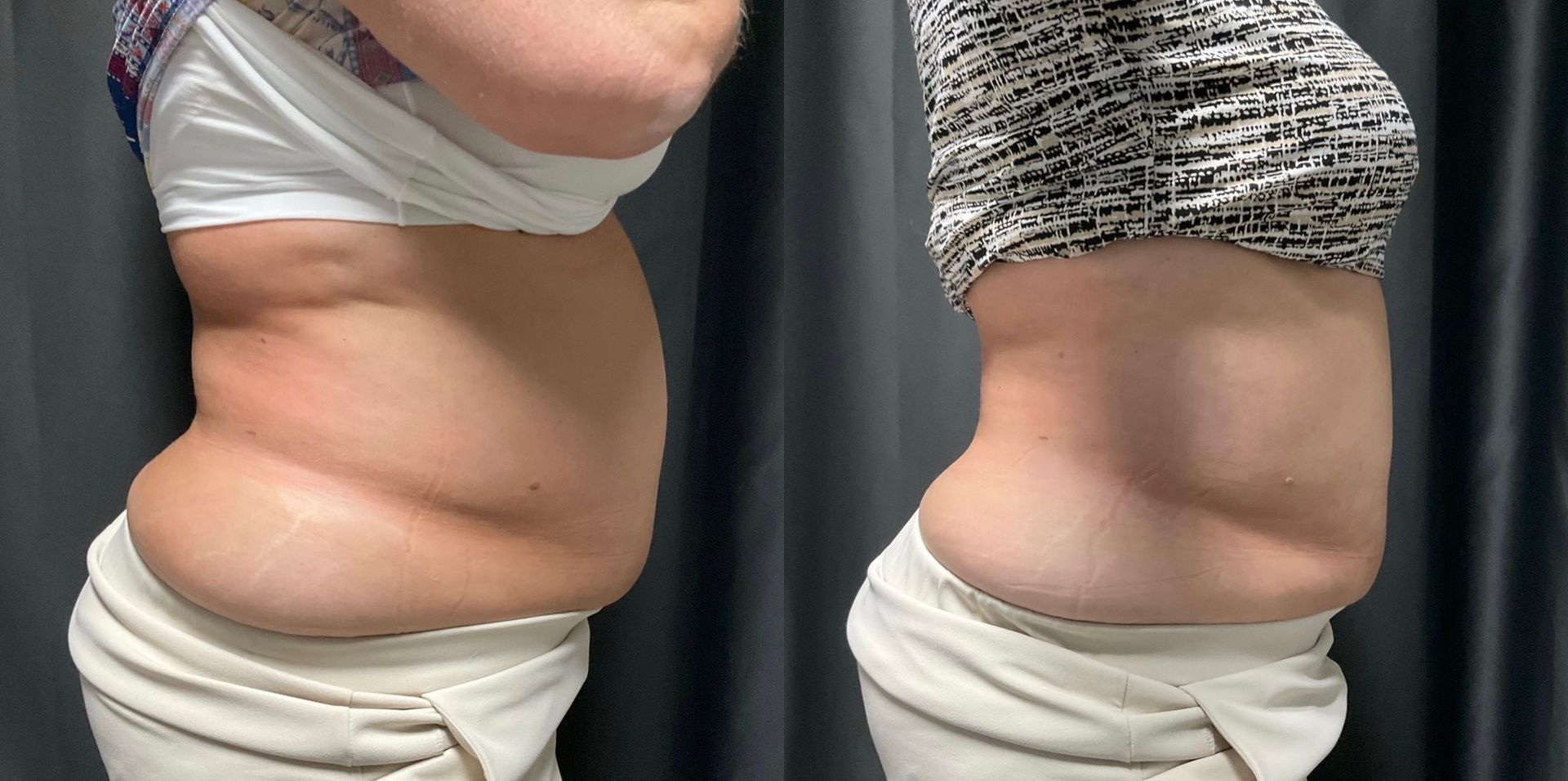 A before and after photo of a woman 's stomach.