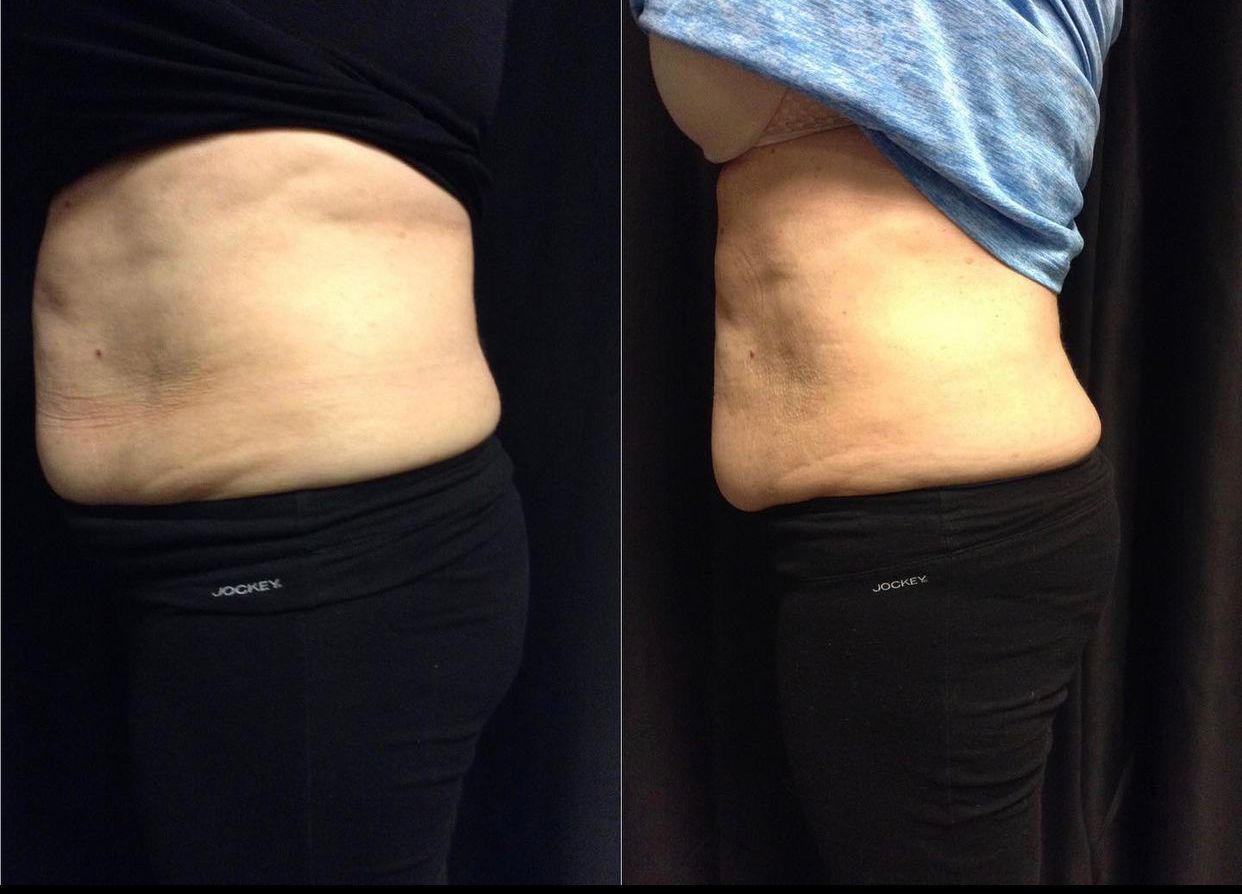 A before and after photo of a woman 's stomach