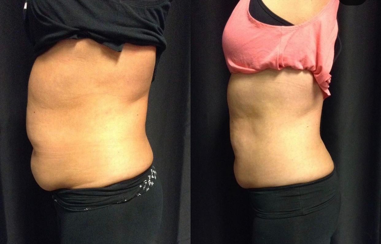 A before and after picture of a woman 's stomach