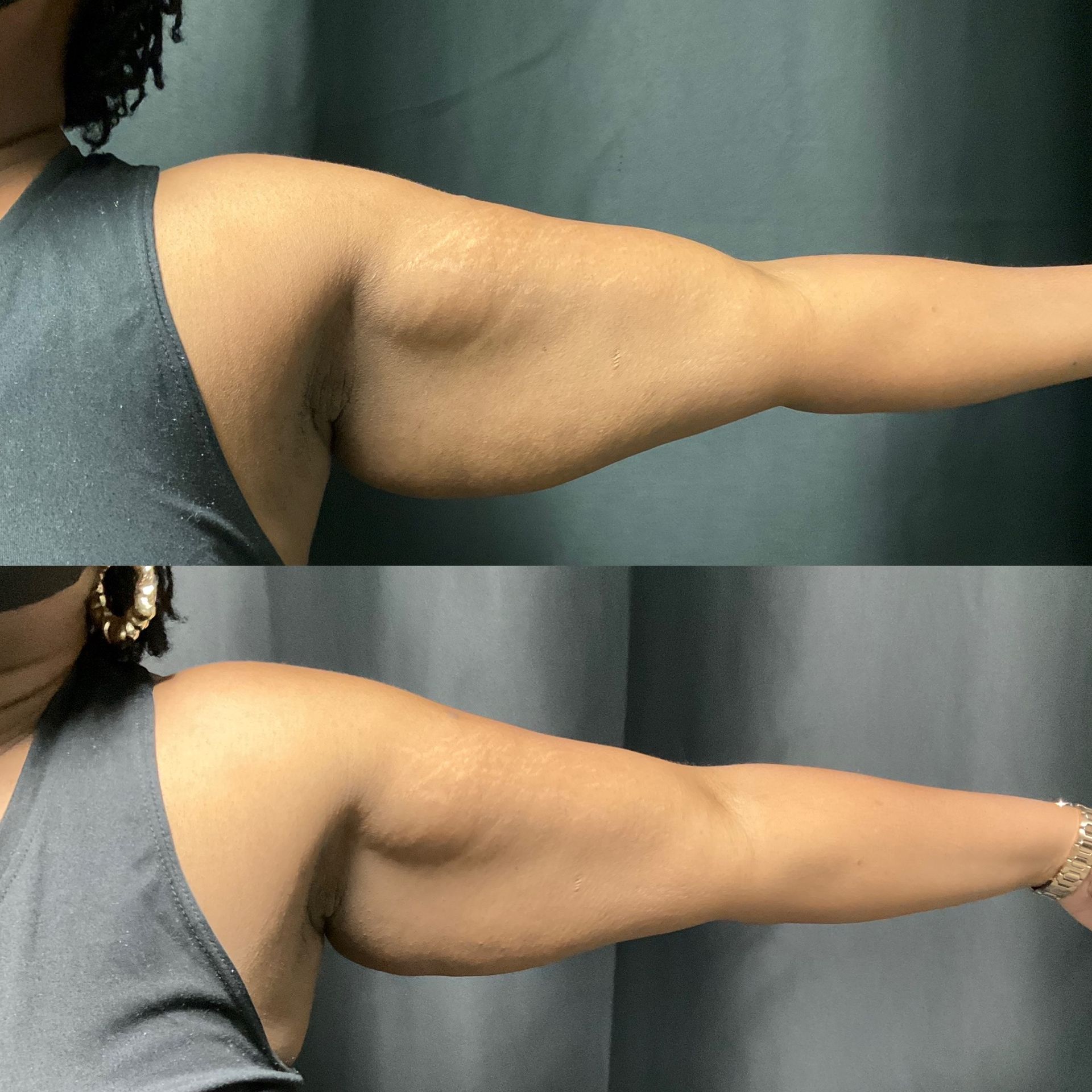 A before and after photo of a woman 's arms.