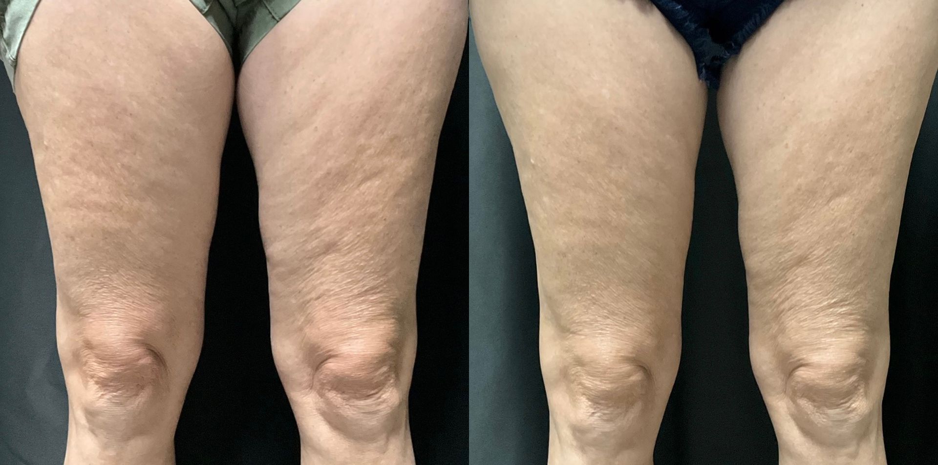 A before and after photo of a woman 's legs with cellulite.