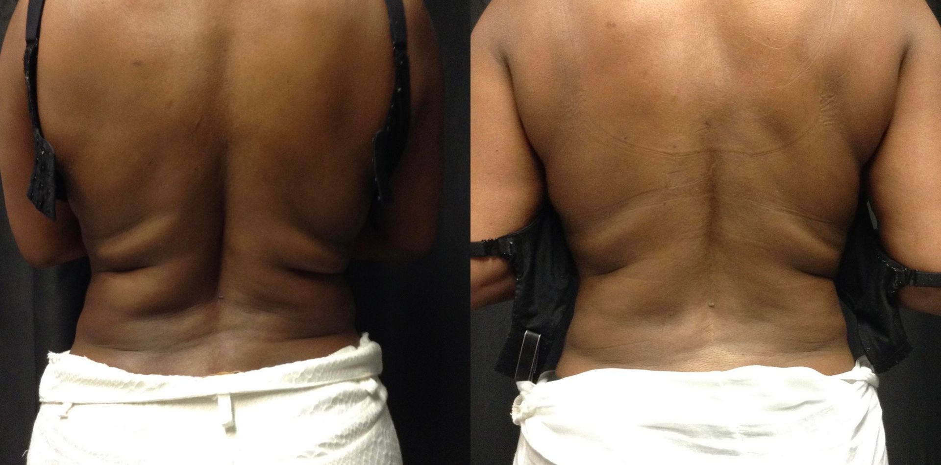 A before and after picture of a woman 's back.