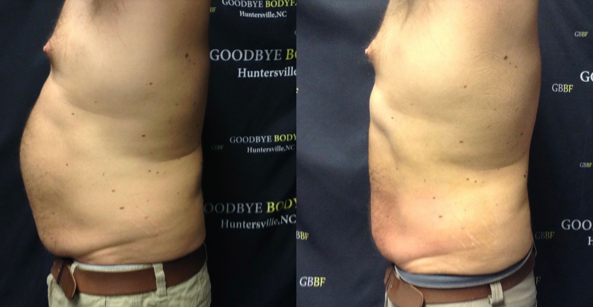 A before and after picture of a man 's stomach.