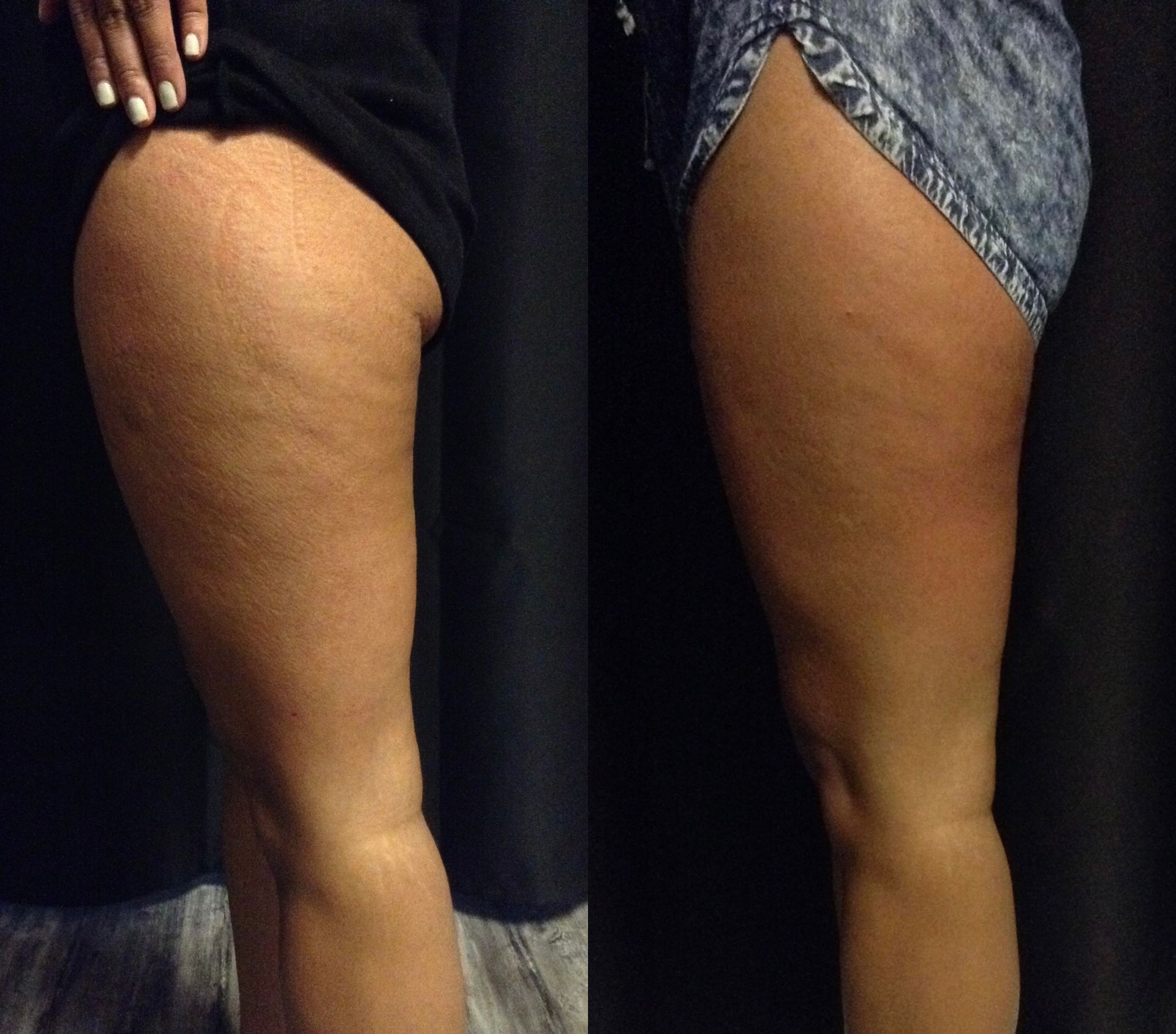 A woman 's legs are shown before and after a treatment
