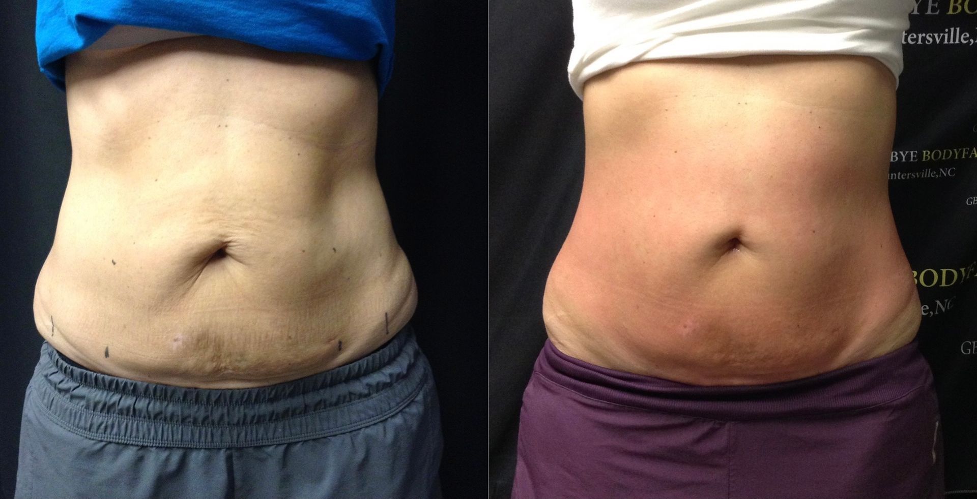 A before and after photo of a woman 's stomach.