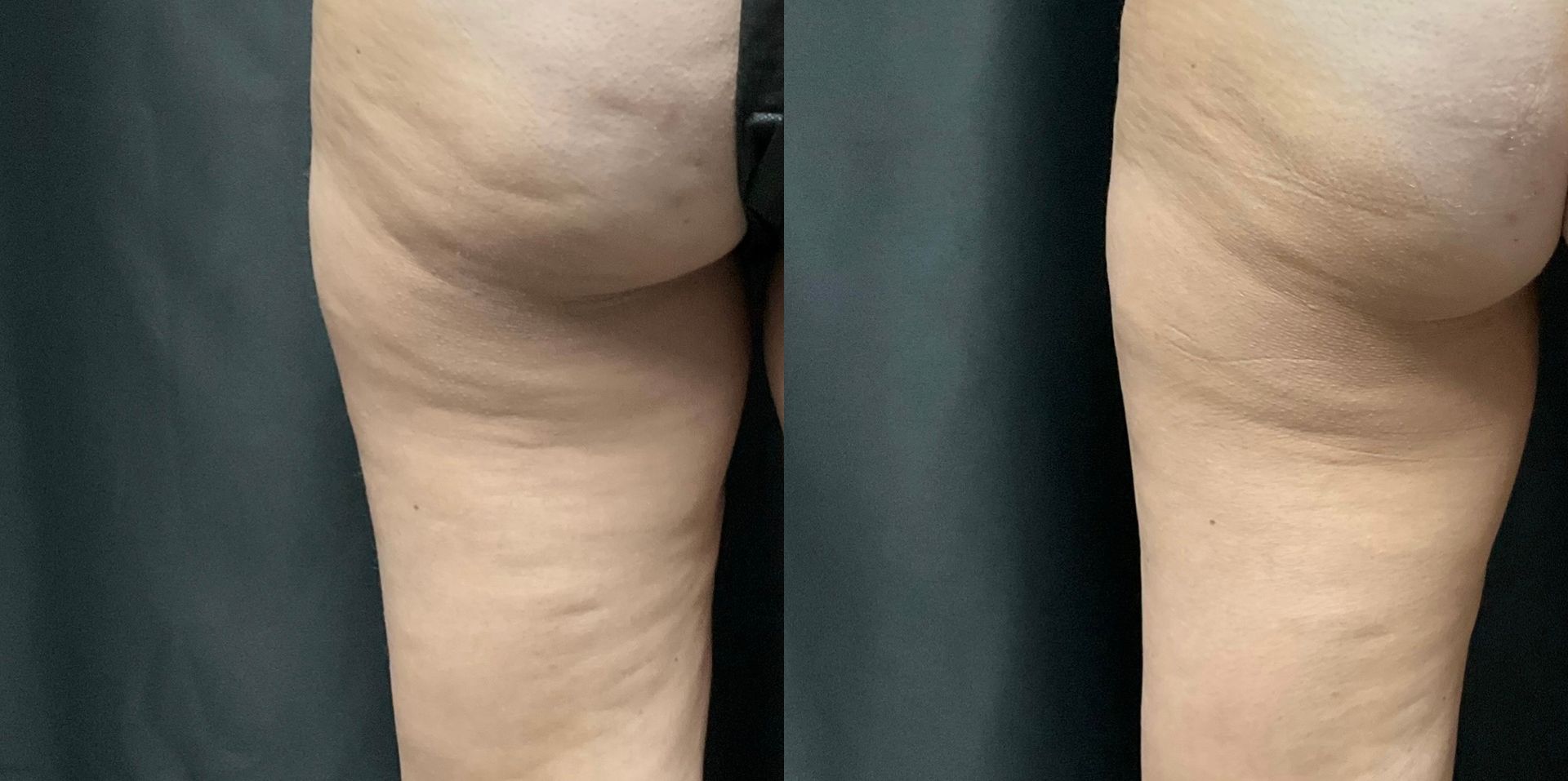 A before and after photo of a woman 's legs with cellulite.