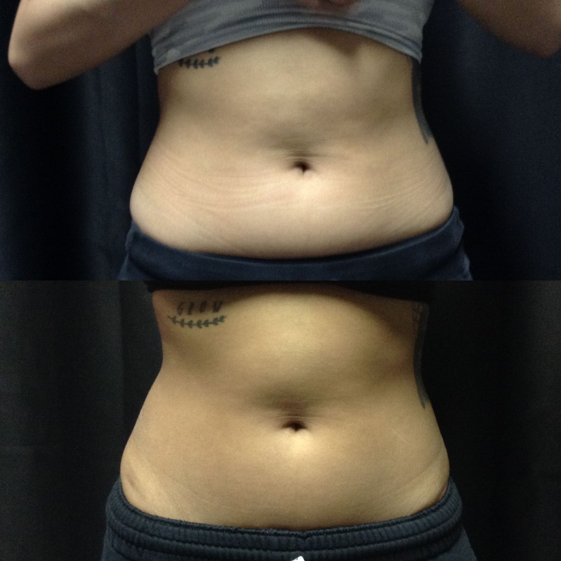 A before and after photo of a woman 's stomach