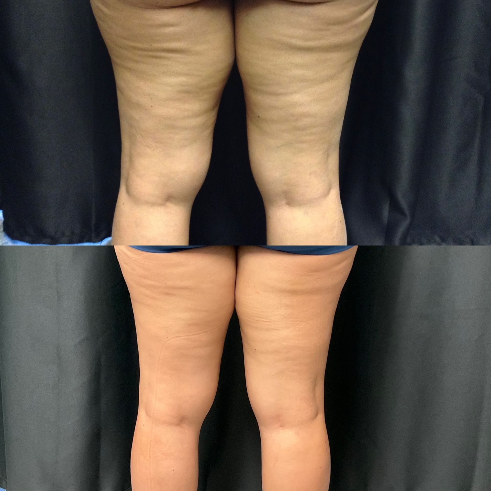 A woman 's legs are shown before and after a treatment