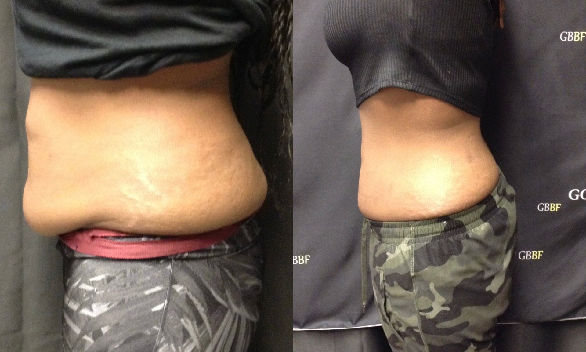 A before and after picture of a woman 's stomach.