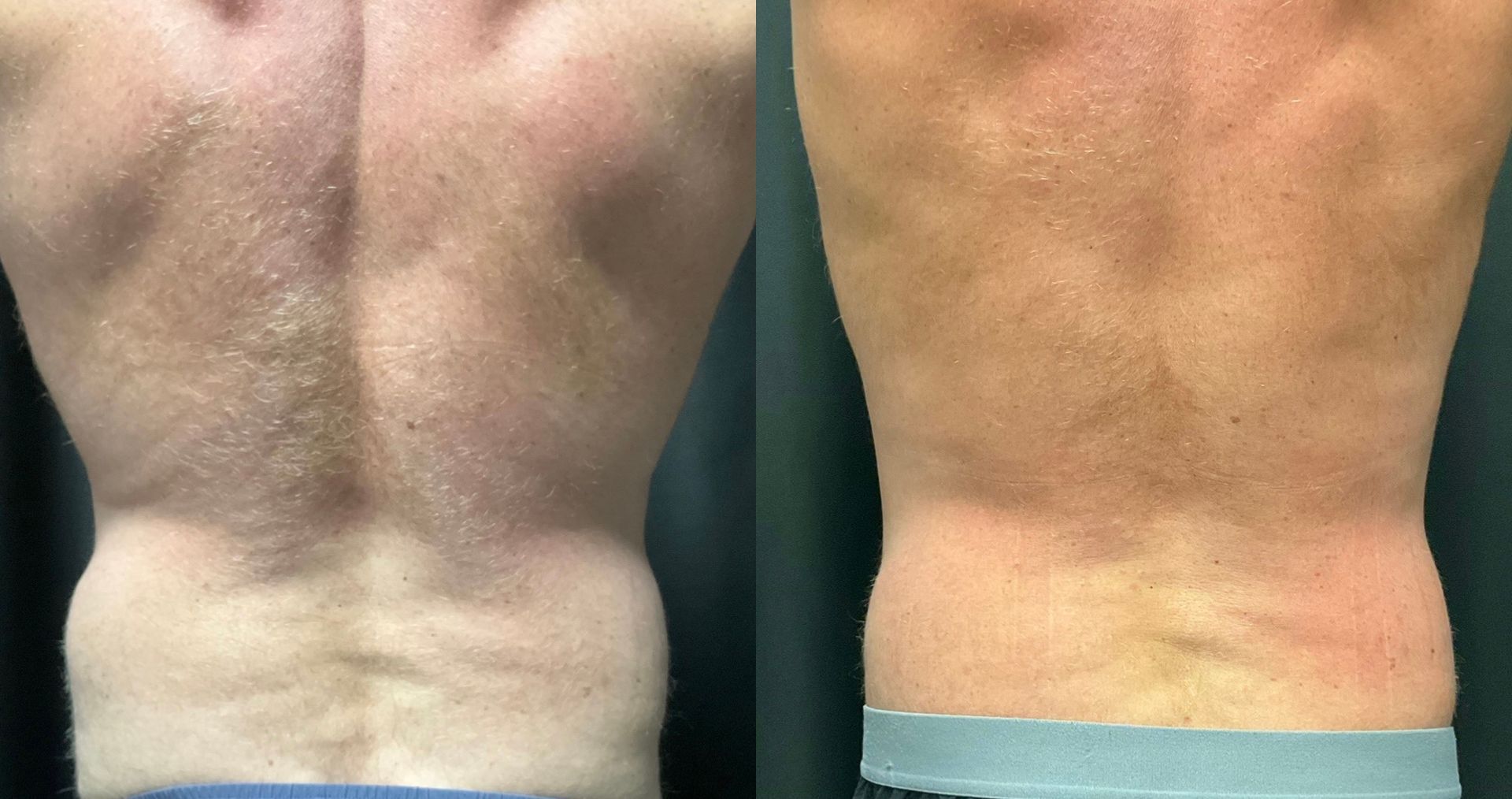 A before and after picture of a man 's back.