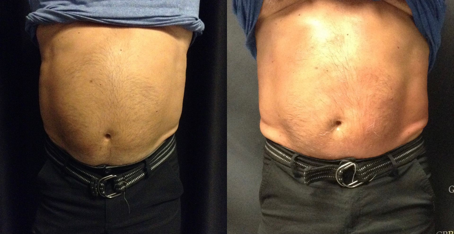 A before and after picture of a man 's stomach.