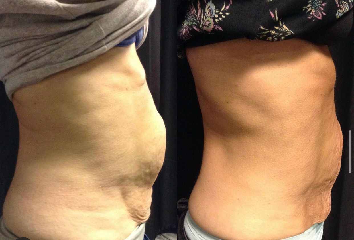 A before and after picture of a woman 's stomach.