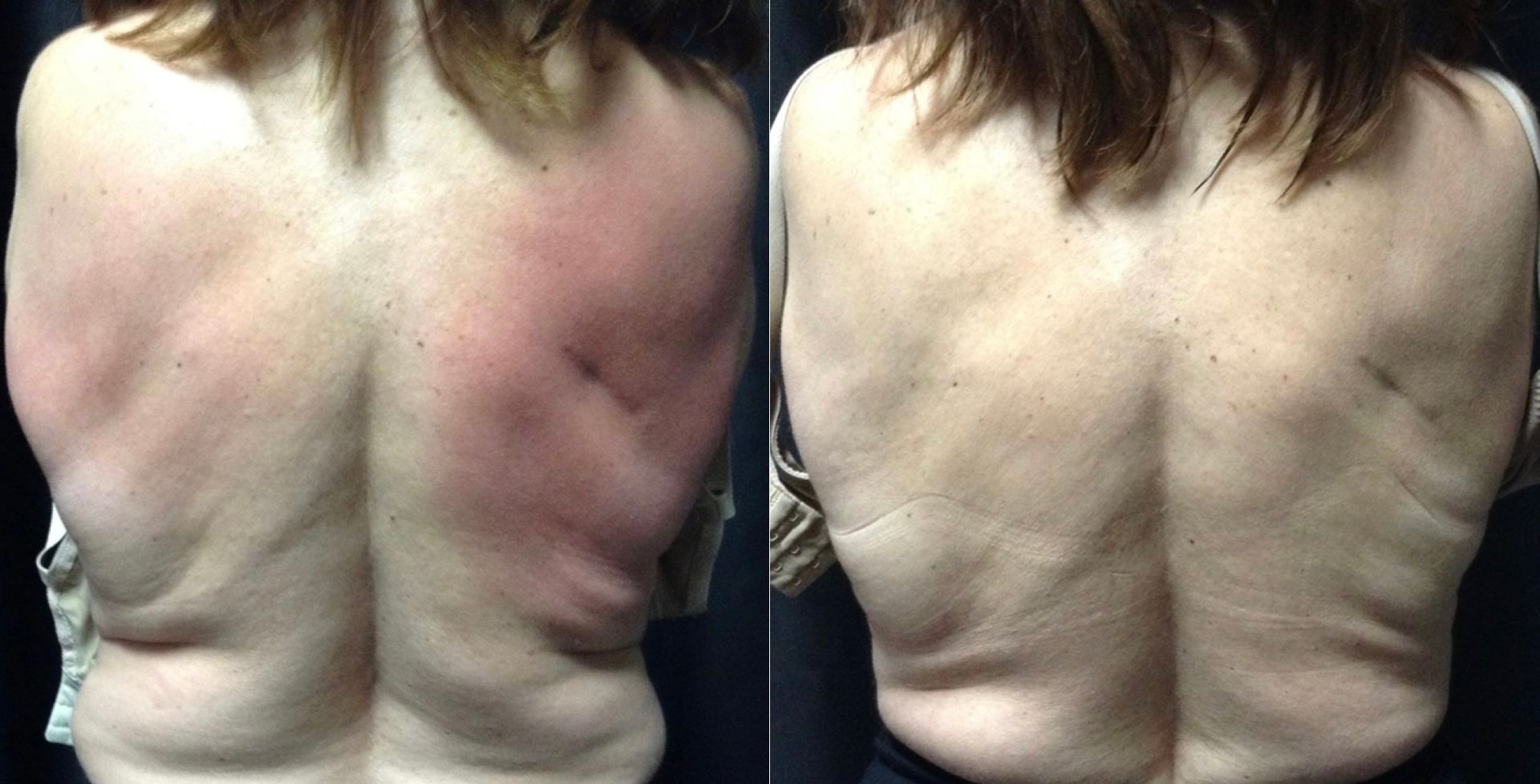 A woman 's back is shown before and after surgery