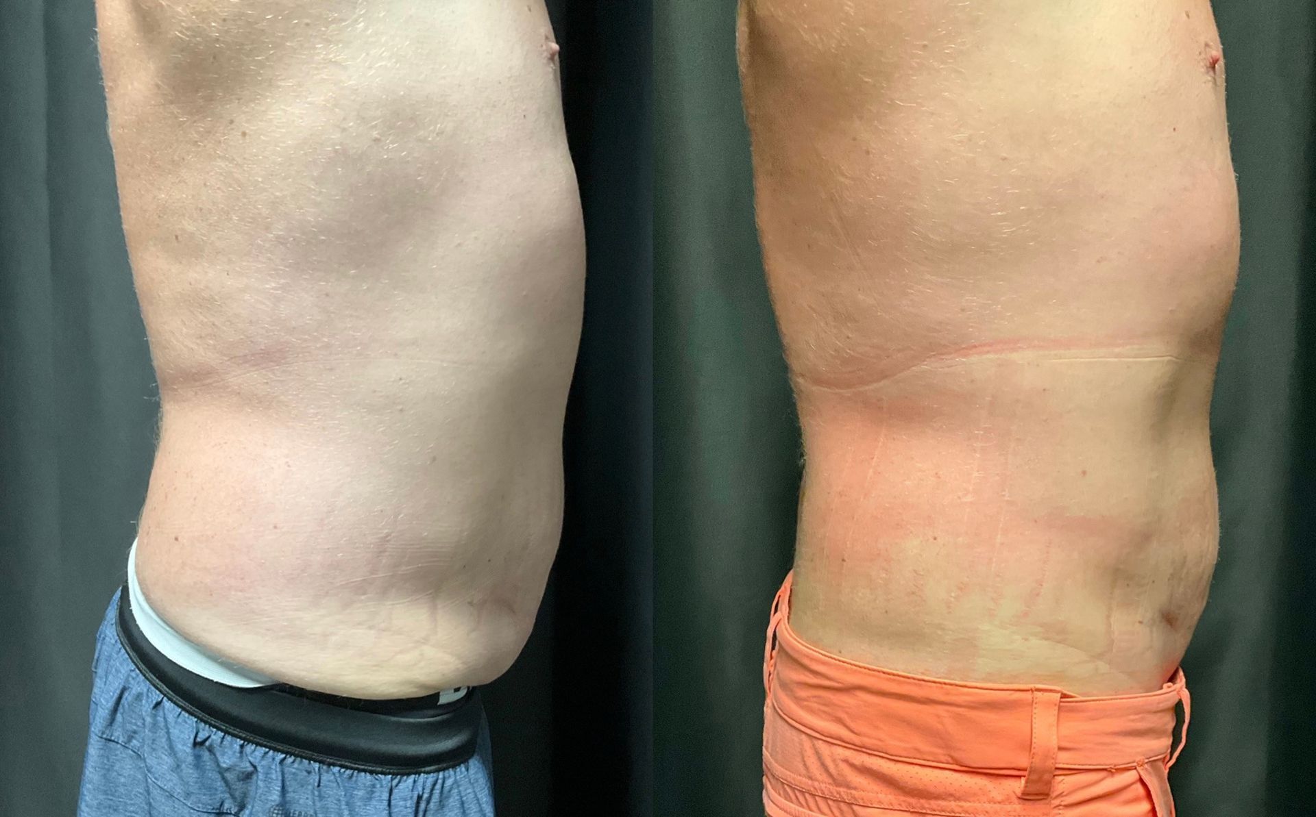 A before and after picture of a man 's stomach.