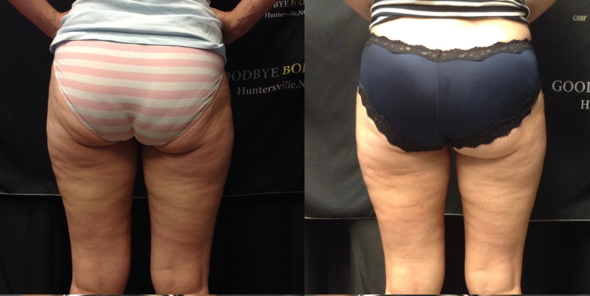 A woman 's legs are shown before and after a treatment.