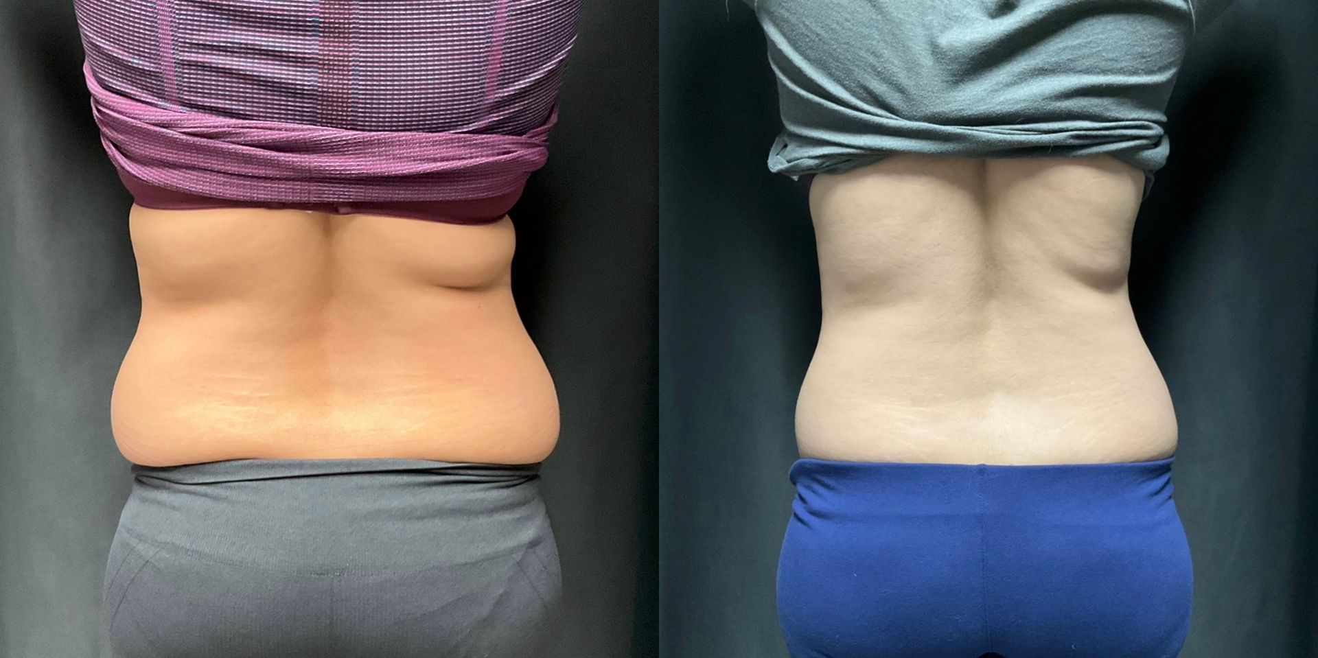 A before and after picture of a woman 's back.