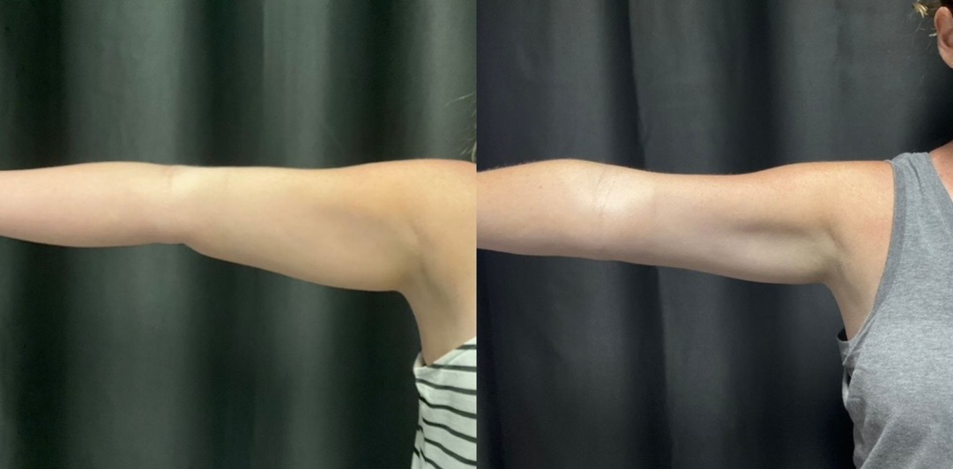 A before and after photo of a woman 's arms.