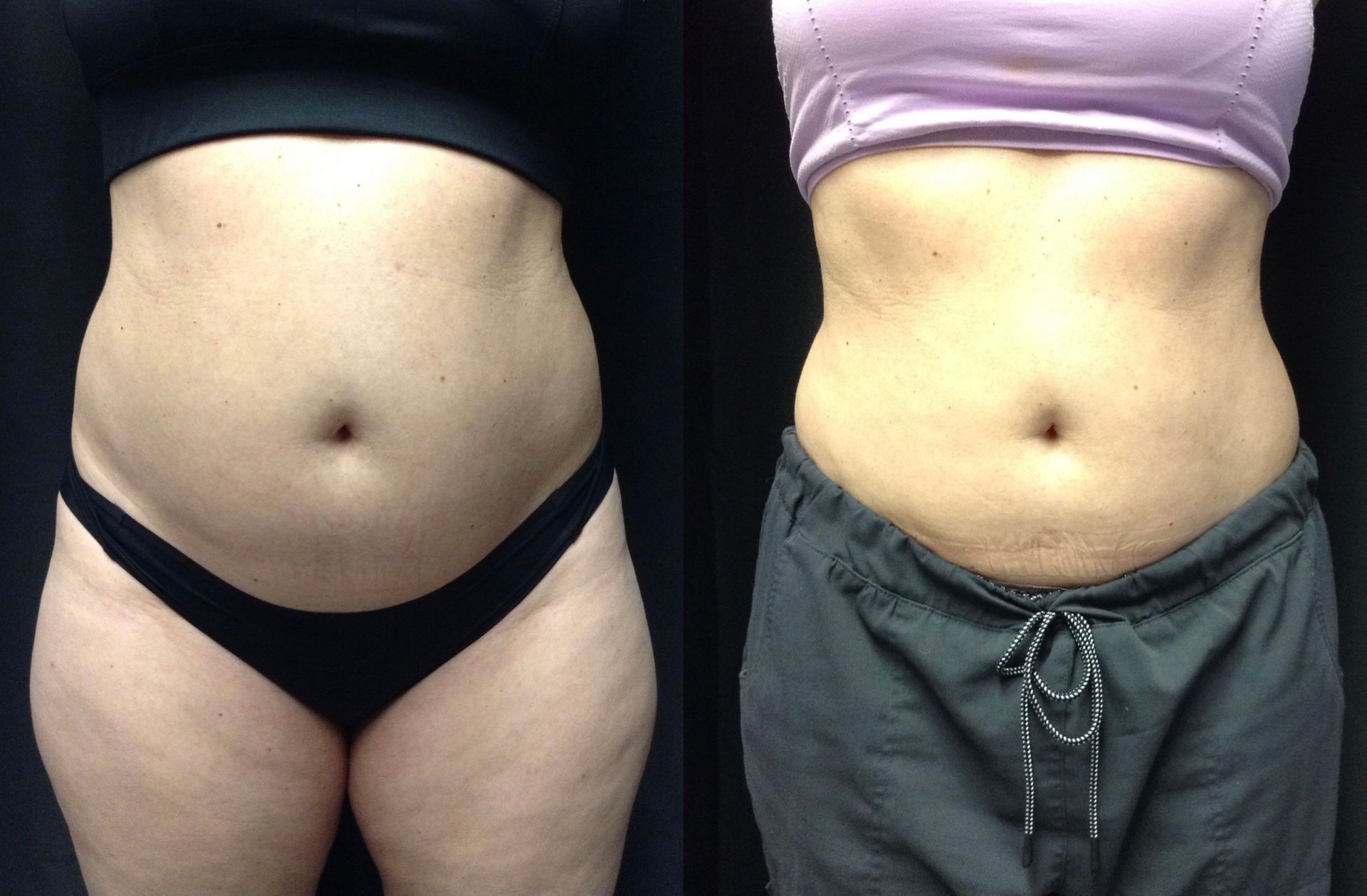 A before and after picture of a woman 's stomach