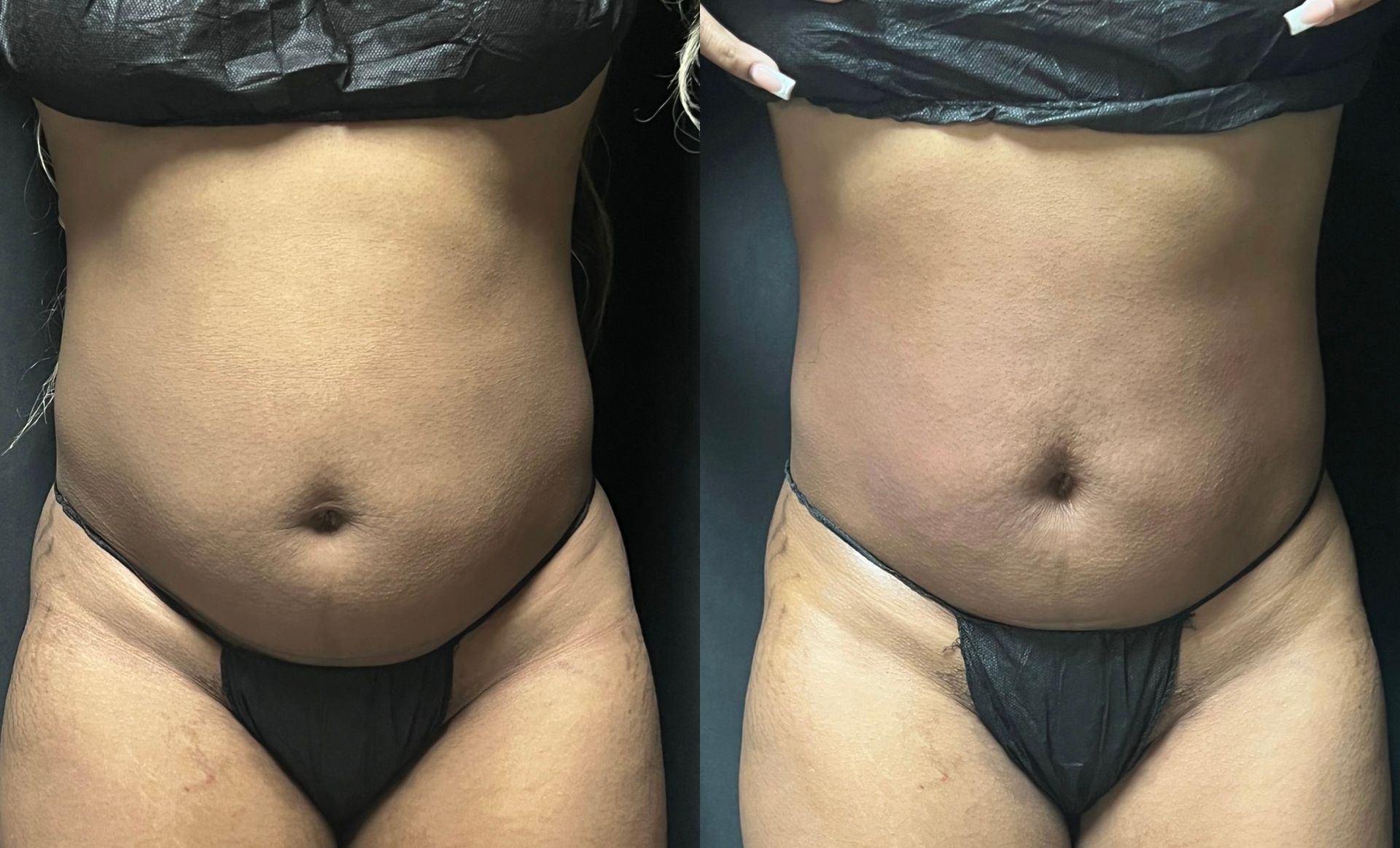 A before and after picture of a woman 's stomach.