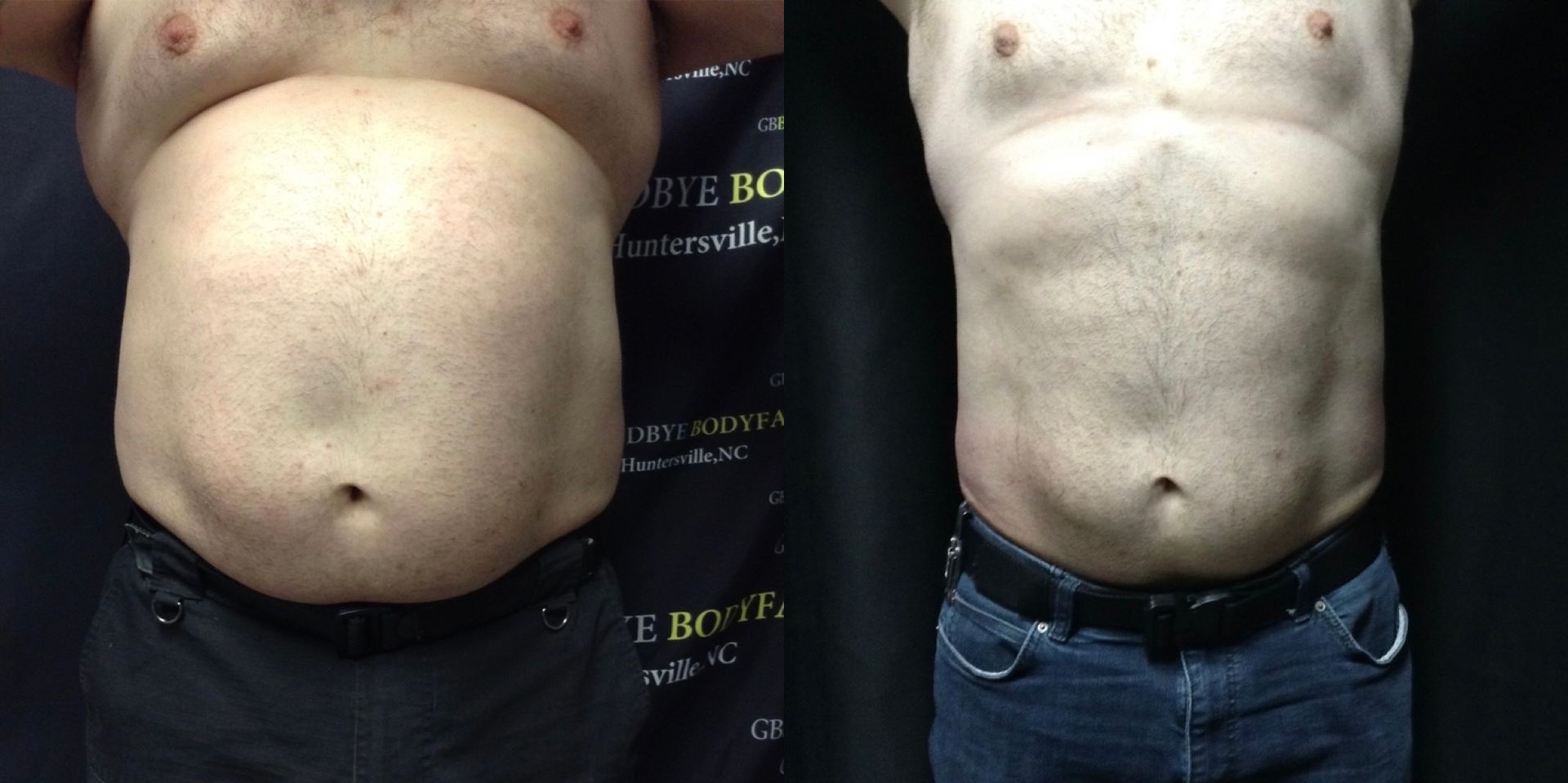 A before and after picture of a man 's stomach.
