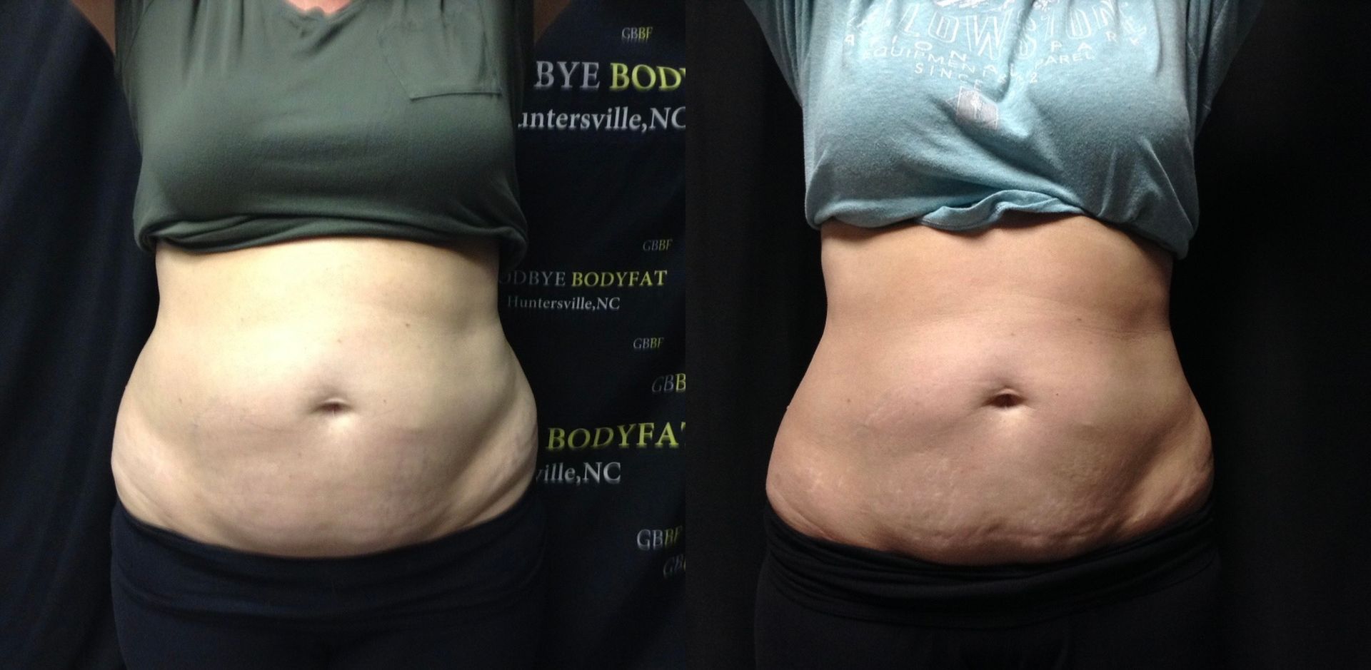 A before and after photo of a woman 's stomach