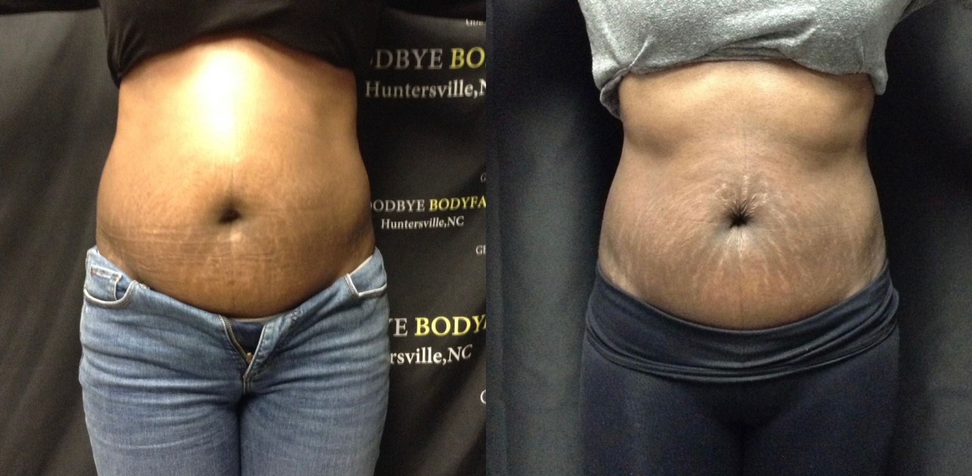 A before and after photo of a woman 's stomach