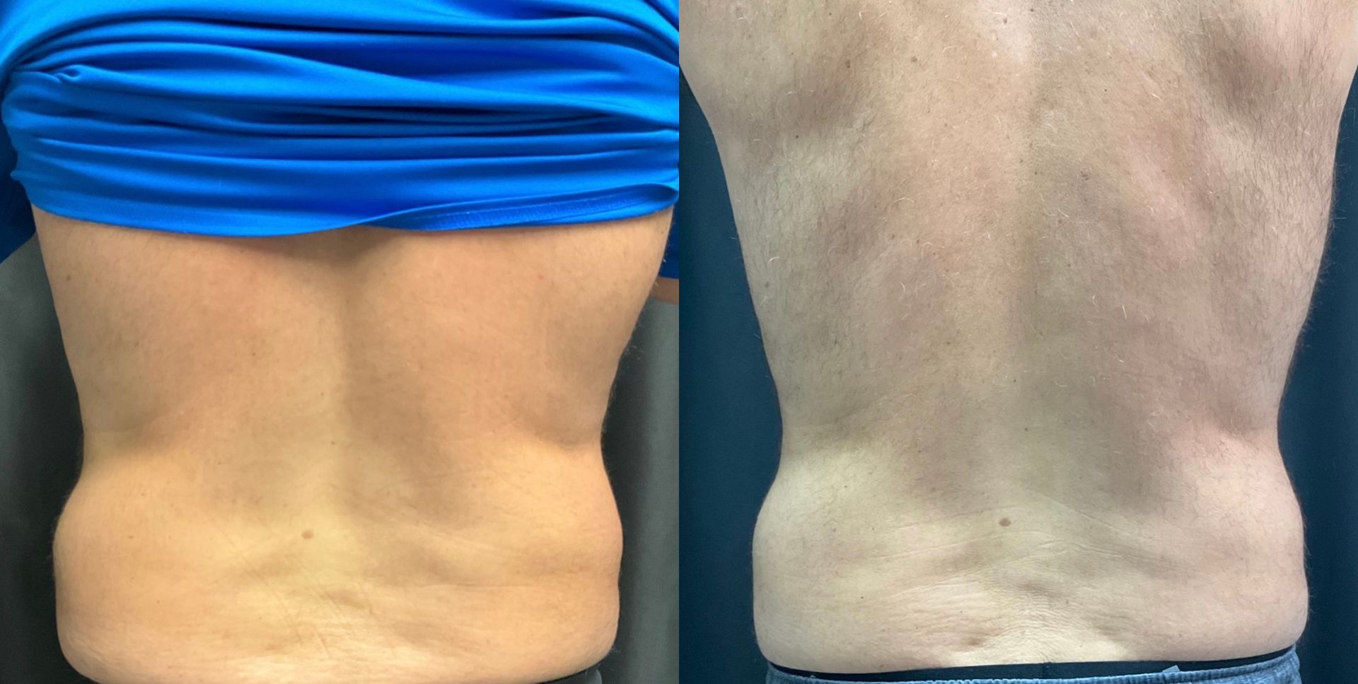 A before and after picture of a man 's back.