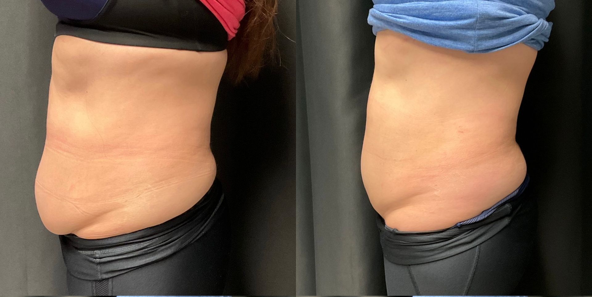 A before and after picture of a woman 's stomach.