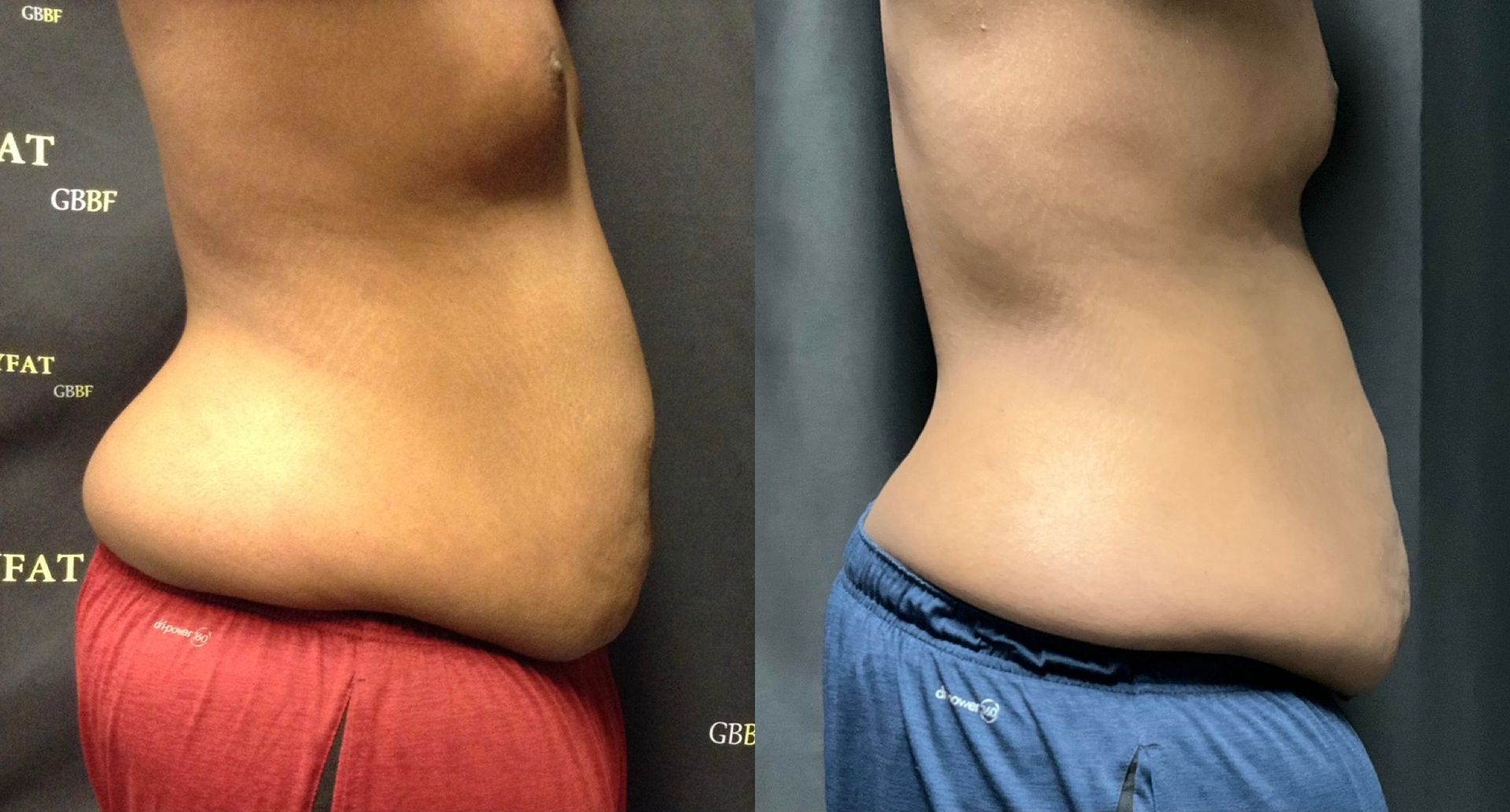 A before and after picture of a woman 's stomach.